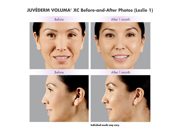 Voluma XC