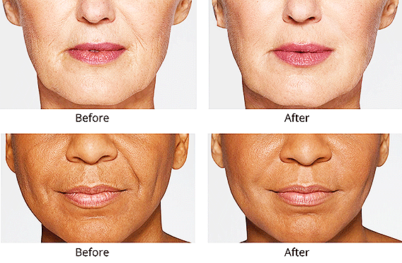 Albuquerque Botox